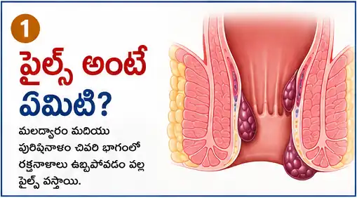 Piles in telugu