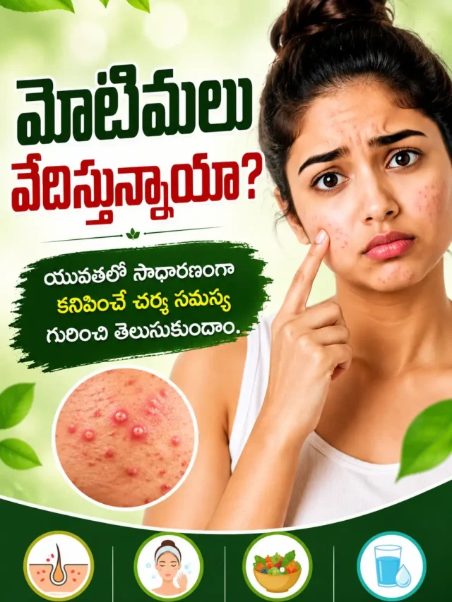 Pimples Treatment Telugu: మొటిమల కారణాలు, నివారణ చిట్కాలు & Healthy Skin Guide